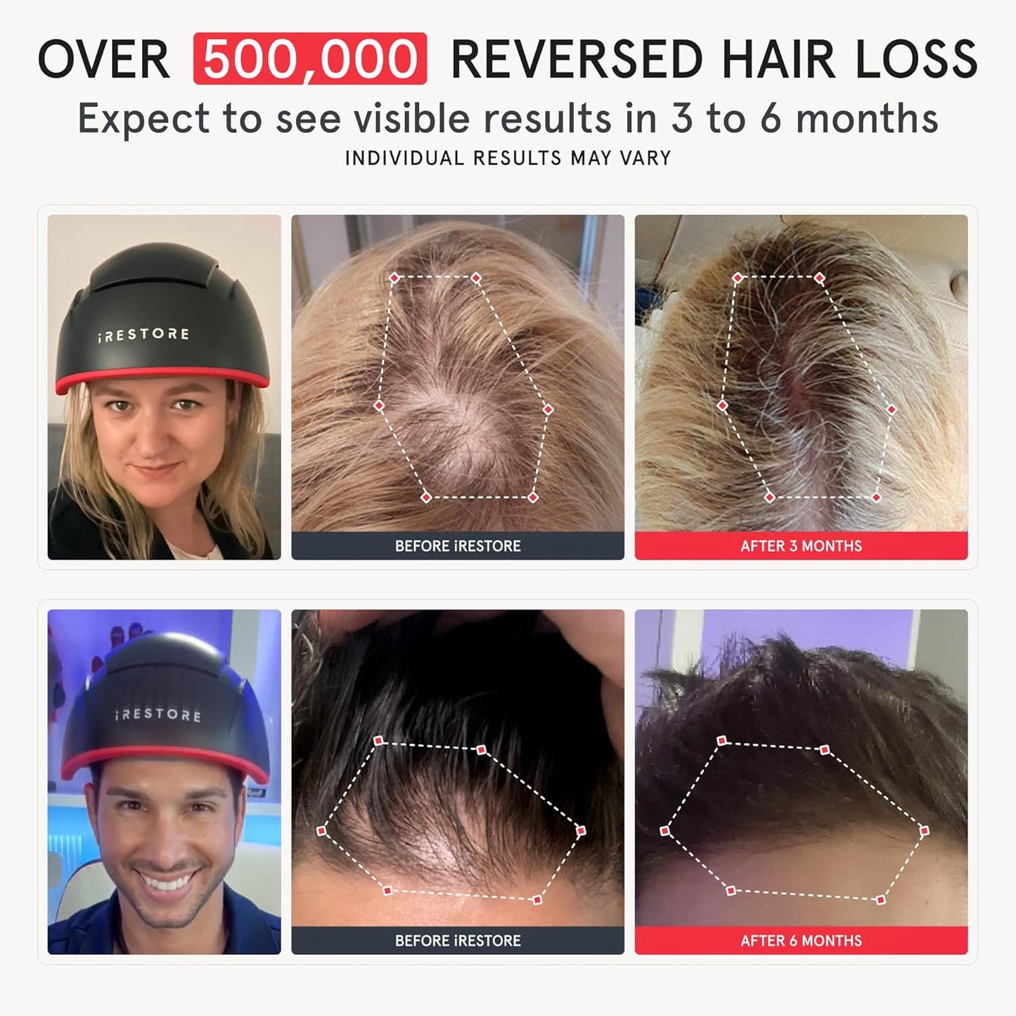 iRESTORE Hair Growth System Elite