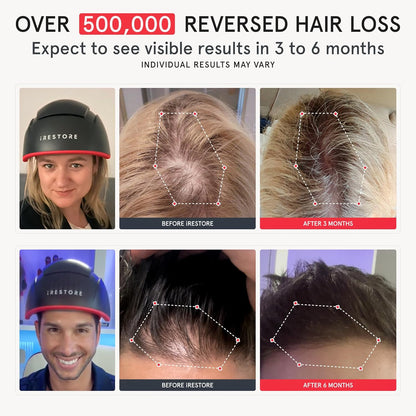 iRESTORE Hair Growth System Elite