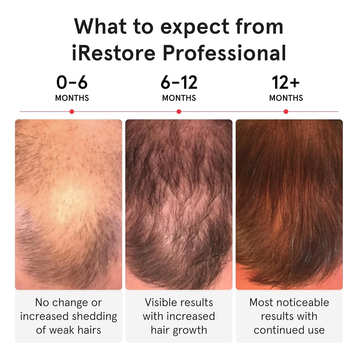 iRESTORE Hair Growth System Professional